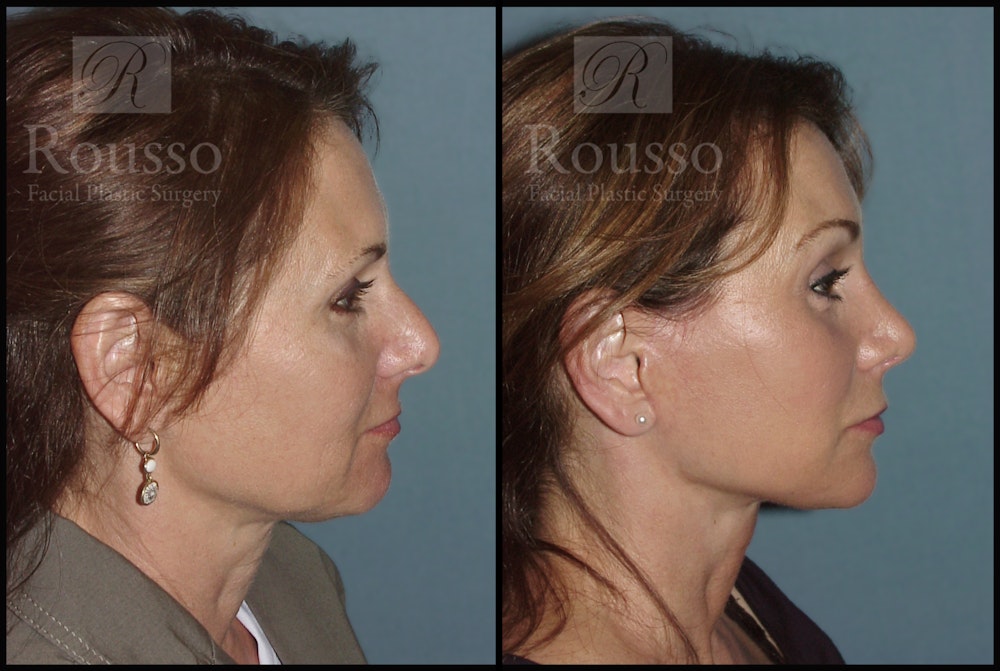 MiniLift Before & After Gallery - Patient 2127513 - Image 3