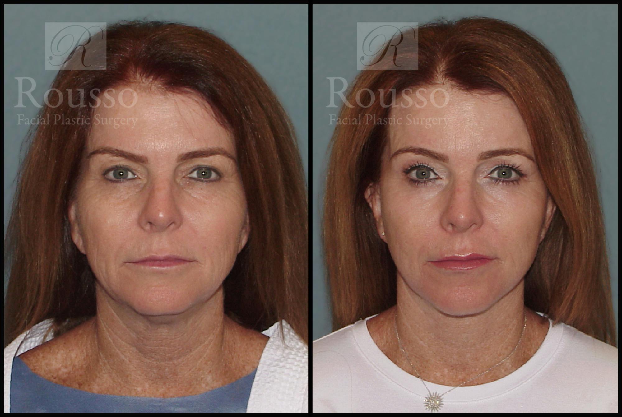 SculptLift in Birmingham Before & After Photos