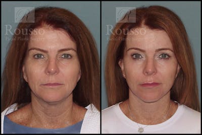 Before & After