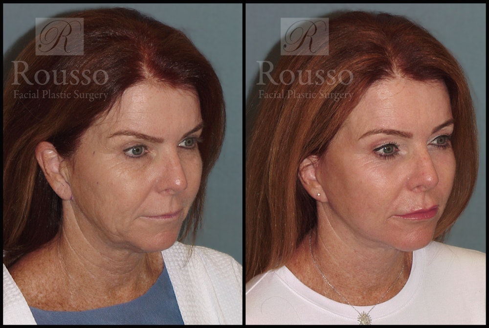 SculptLift™ Before & After Gallery - Patient 2127529 - Image 2