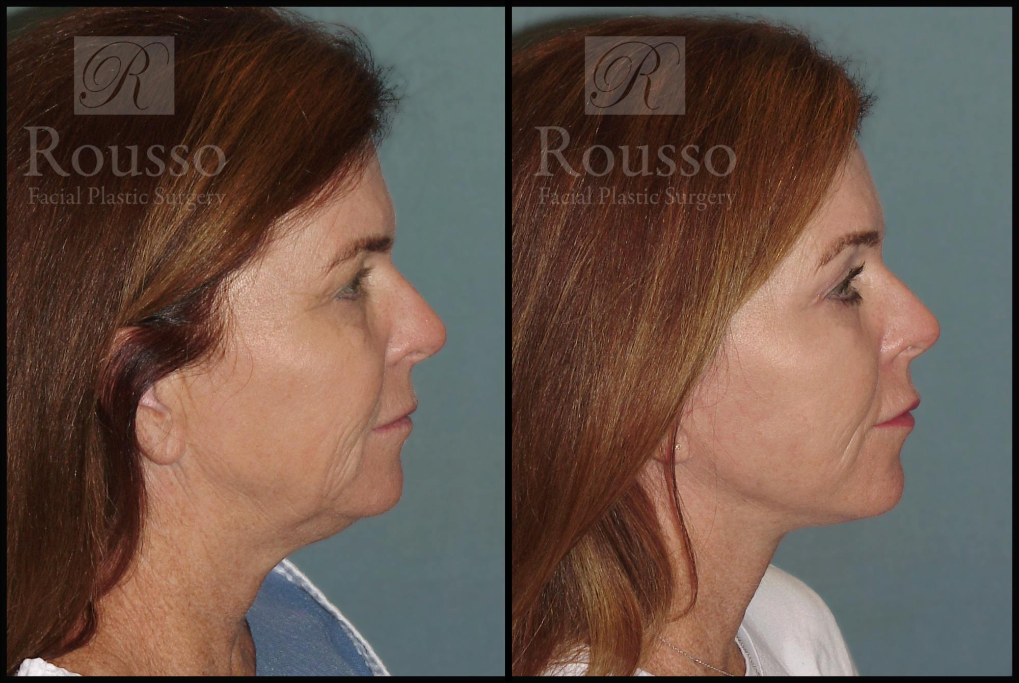 Before & After Image