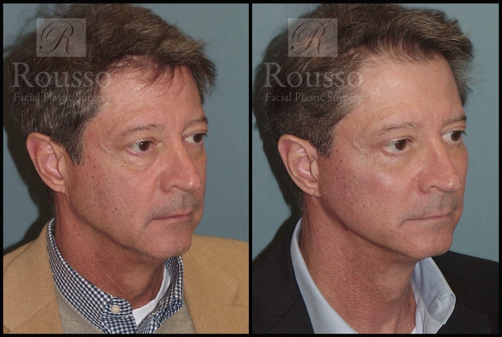 Facial Implants Before & After Gallery - Patient 2128757 - Image 3