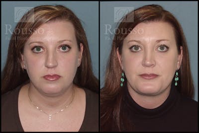 Facial Implants Before & After Gallery - Patient 2128758 - Image 2