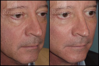 Facial Implants <span class=small>By Dr. Daniel Rousso</span> Before & After Gallery - Patient 2128757 - Image 2