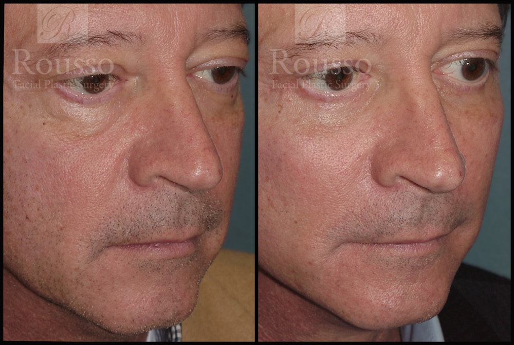 Facial Implants Before & After Gallery - Patient 2128757 - Image 2