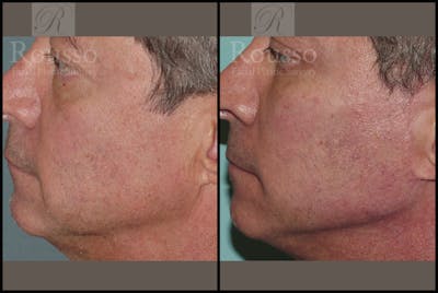 Facial Implants Before & After Gallery - Patient 2128757 - Image 1