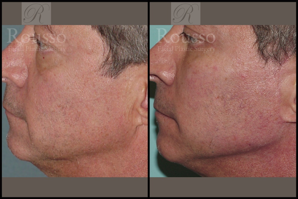 Facial Implants Before & After Gallery - Patient 2128757 - Image 1