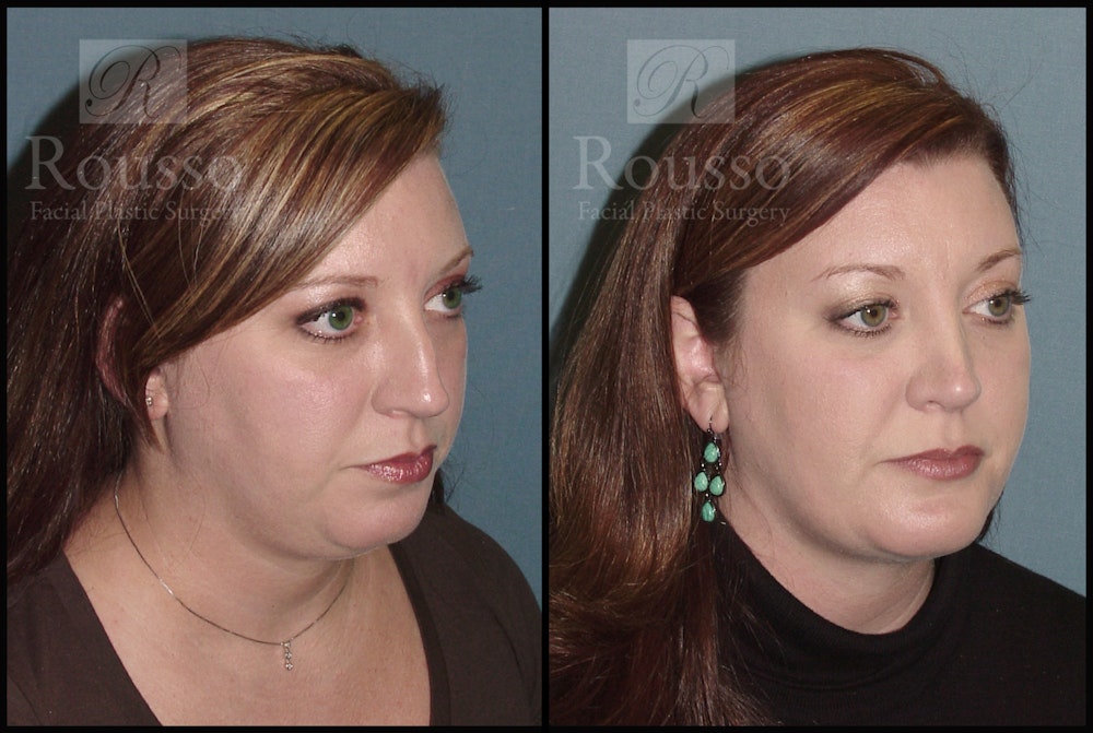 Facial Implants Before & After Gallery - Patient 147124263 - Image 3