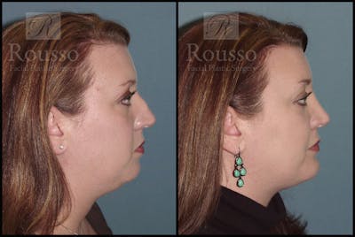 Facial Implants Before & After Gallery - Patient 147124263 - Image 1