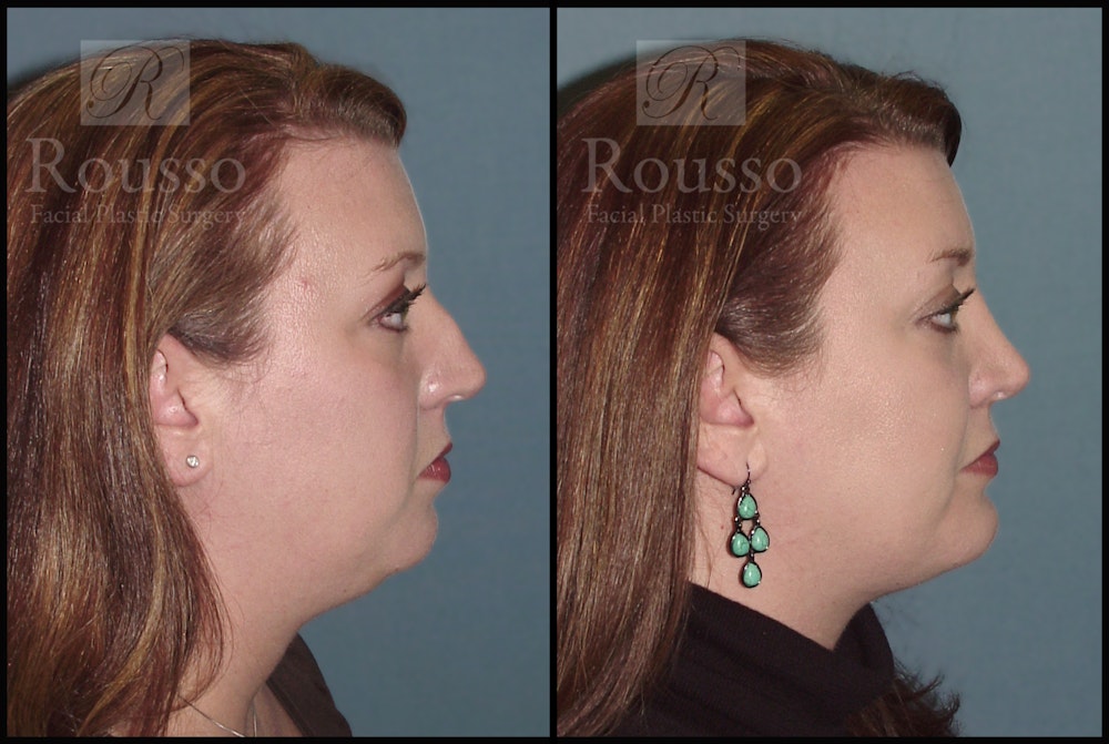 Facial Implants Before & After Gallery - Patient 2128758 - Image 1