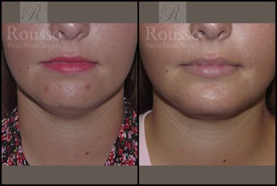 Facial Implants <span class=small>By Dr. Daniel Rousso</span> Before & After Gallery - Patient 2128759 - Image 2