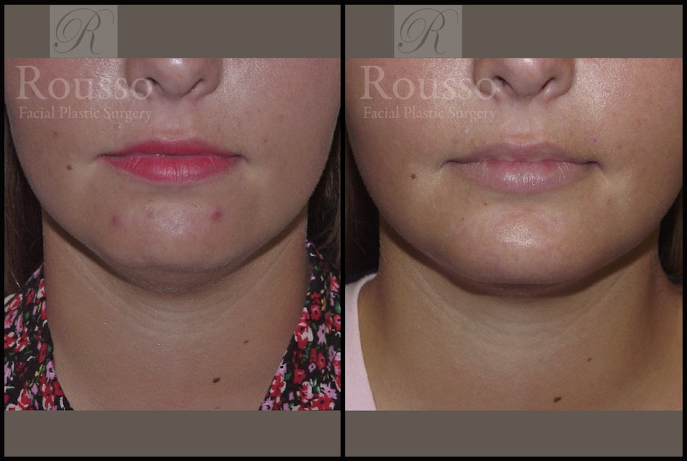 Facial Implants <span class=small>By Dr. Daniel Rousso</span> Before & After Gallery - Patient 2128759 - Image 2