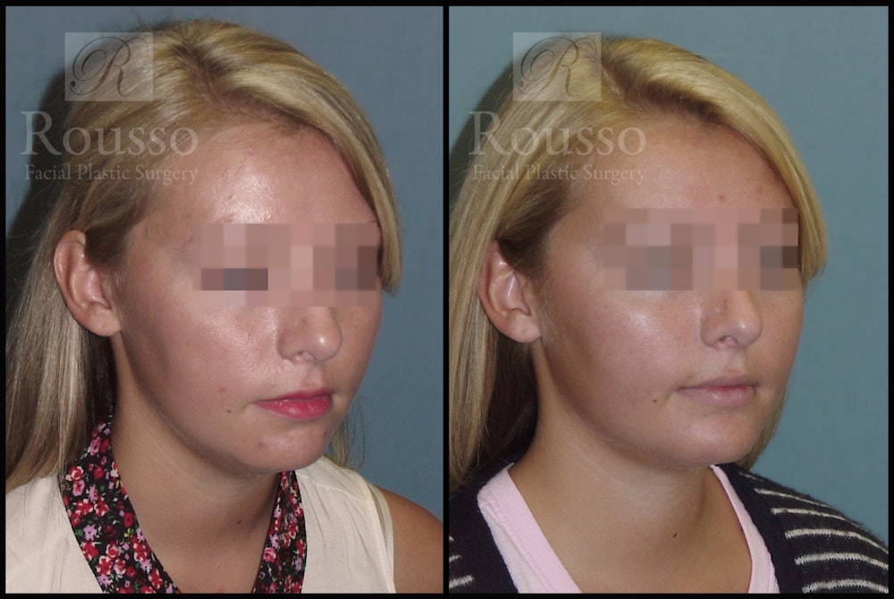 Facial Implants Before & After Gallery - Patient 147124264 - Image 3