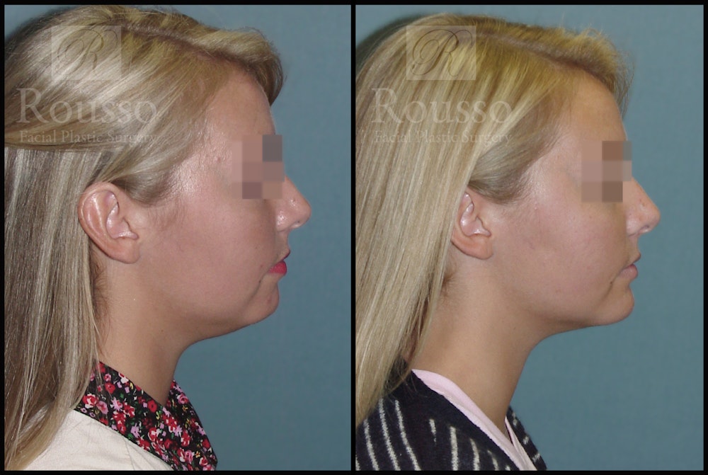 Facial Implants Before & After Gallery - Patient 147124264 - Image 1