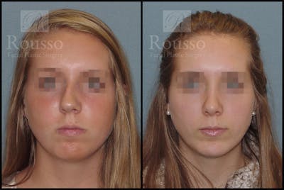 Facial Implants Before & After Gallery - Patient 147124265 - Image 2