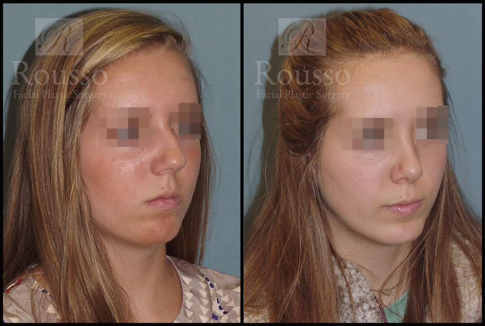 Facial Implants Before & After Gallery - Patient 147124265 - Image 3