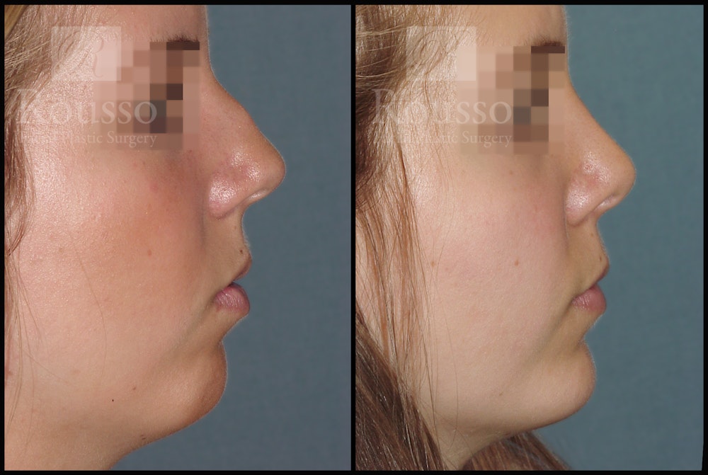 Facial Implants Before & After Gallery - Patient 147124265 - Image 1