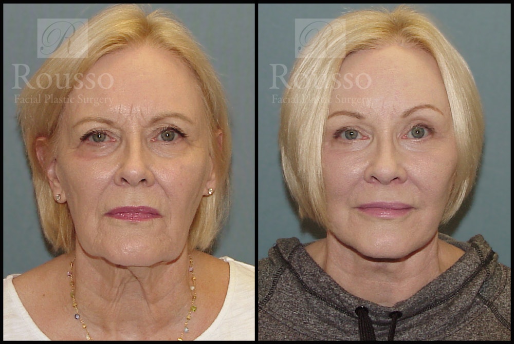 SculptLift™ Before & After Gallery - Patient 2128762 - Image 1