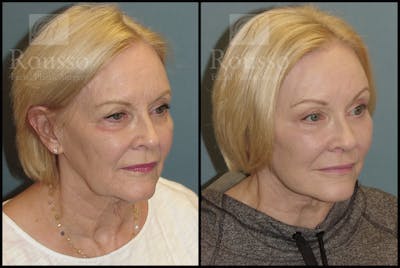 SculptLift™ Before & After Gallery - Patient 2128762 - Image 2