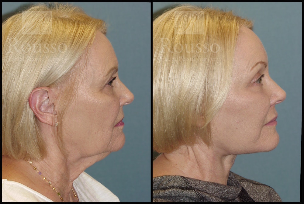 SculptLift™ Before & After Gallery - Patient 2128762 - Image 3
