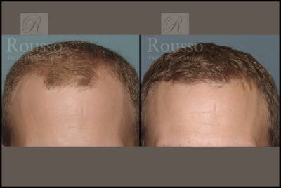 Hair Transplant Before & After Gallery - Patient 2153962 - Image 1