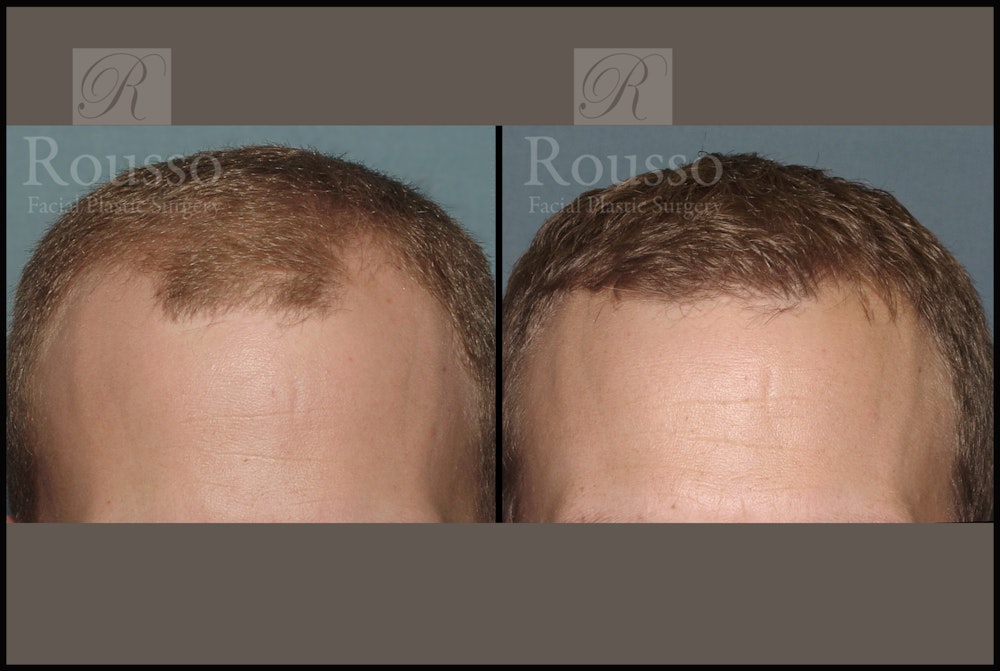 Hair Transplant Before & After Gallery - Patient 2153962 - Image 1