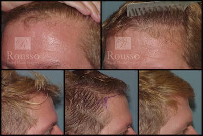 Hair Transplant Before & After Gallery - Patient 2153963 - Image 1