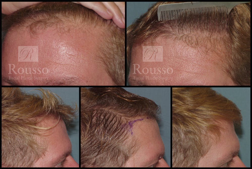 Hair Transplant Gallery - Patient 2153963 - Image 1