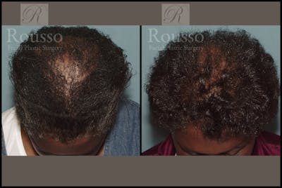 Hair Transplant Gallery - Patient 2153964 - Image 1