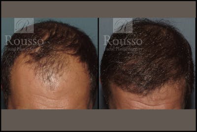 Hair Transplant Before & After Gallery - Patient 2153965 - Image 1