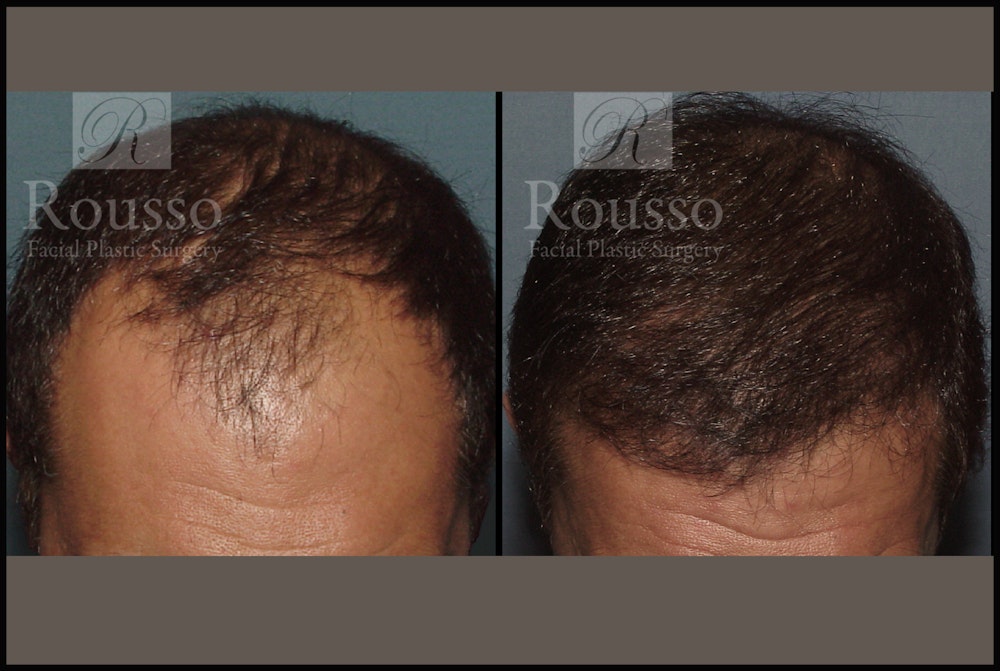 Hair Transplant Before & After Gallery - Patient 2153965 - Image 1