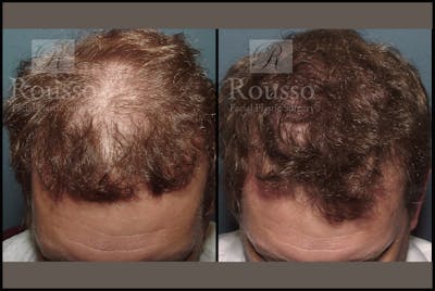 Hair Transplant Before & After Gallery - Patient 2153966 - Image 1
