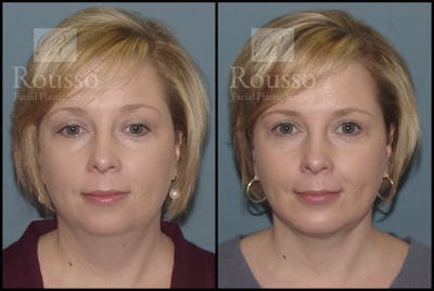 Facial Implants Before & After Gallery - Patient 147124266 - Image 1