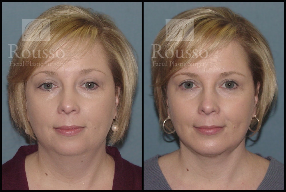 Facial Implants Before & After Gallery - Patient 2205360 - Image 1