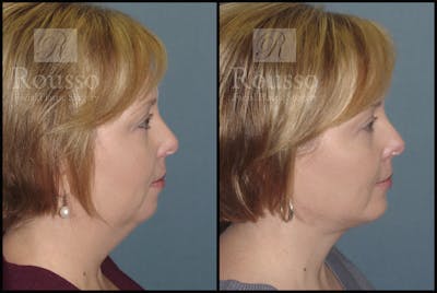 Facial Implants Before & After Gallery - Patient 147124266 - Image 2