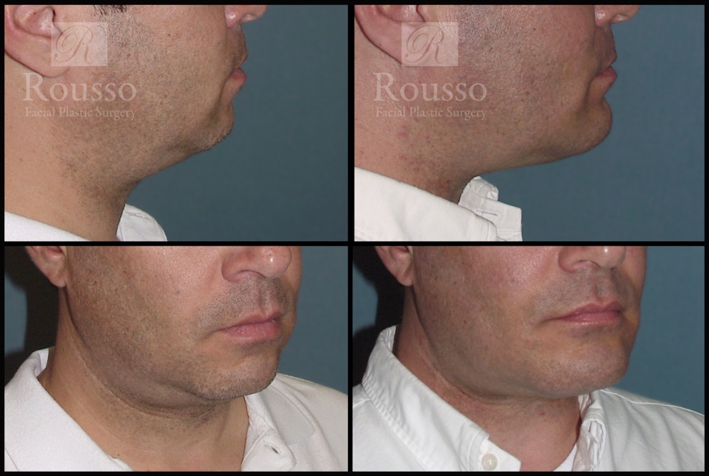 Facial Implants Before & After Gallery - Patient 2205361 - Image 1