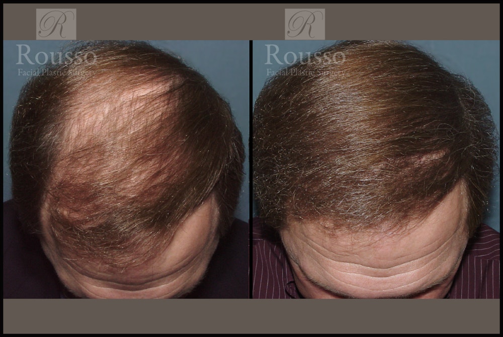 Hair Transplant Gallery - Patient 2205365 - Image 1