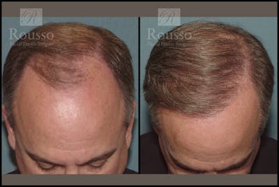 Hair Transplant Before & After Gallery - Patient 2205366 - Image 1