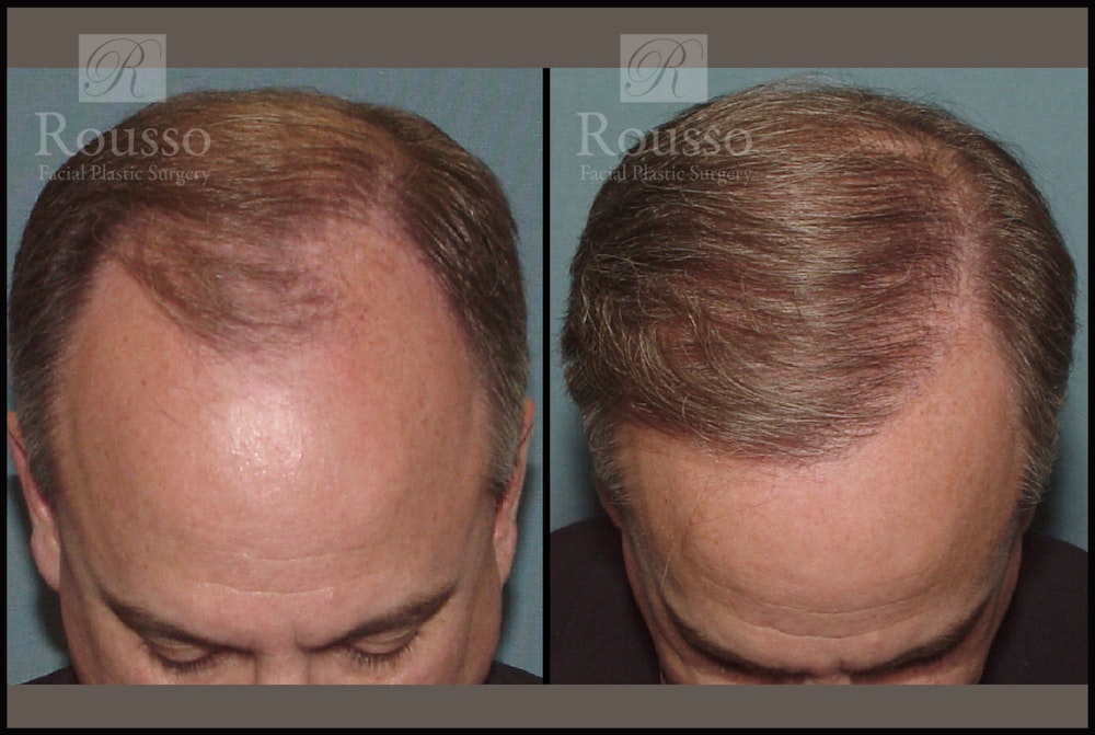 Hair Transplant Before & After Gallery - Patient 2205366 - Image 1