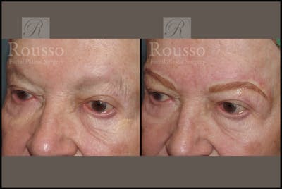 Microblading Before & After Gallery - Patient 2205367 - Image 1