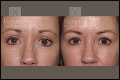 Microblading Before & After Gallery - Patient 2205368 - Image 1