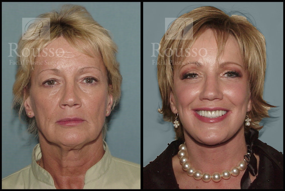 Facelift Before & After Gallery - Patient 1993263 - Image 3