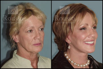 Facelift Before & After Gallery - Patient 1993263 - Image 1