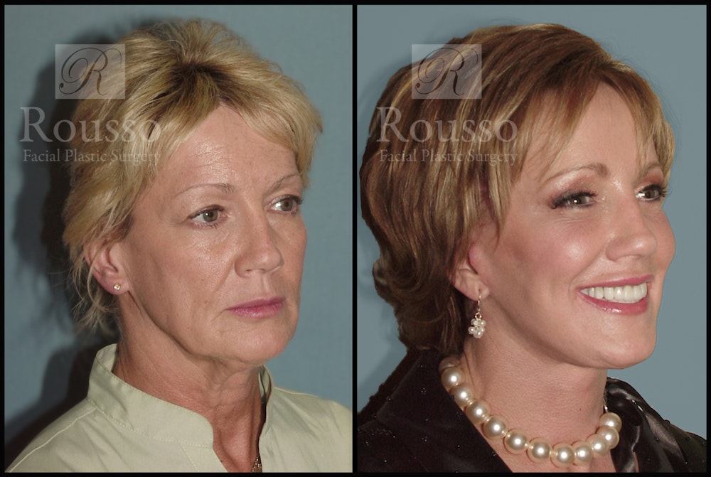Facelift Before & After Gallery - Patient 1993263 - Image 1