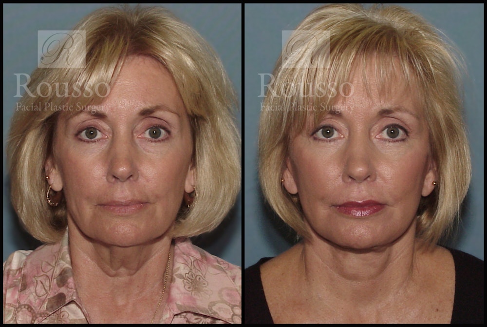 Facelift Before & After Gallery - Patient 1993265 - Image 3