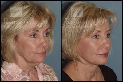 Facelift Before & After Gallery - Patient 1993265 - Image 1