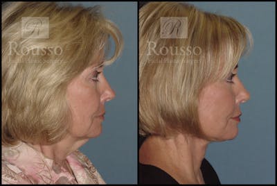 Facelift Before & After Gallery - Patient 1993265 - Image 2