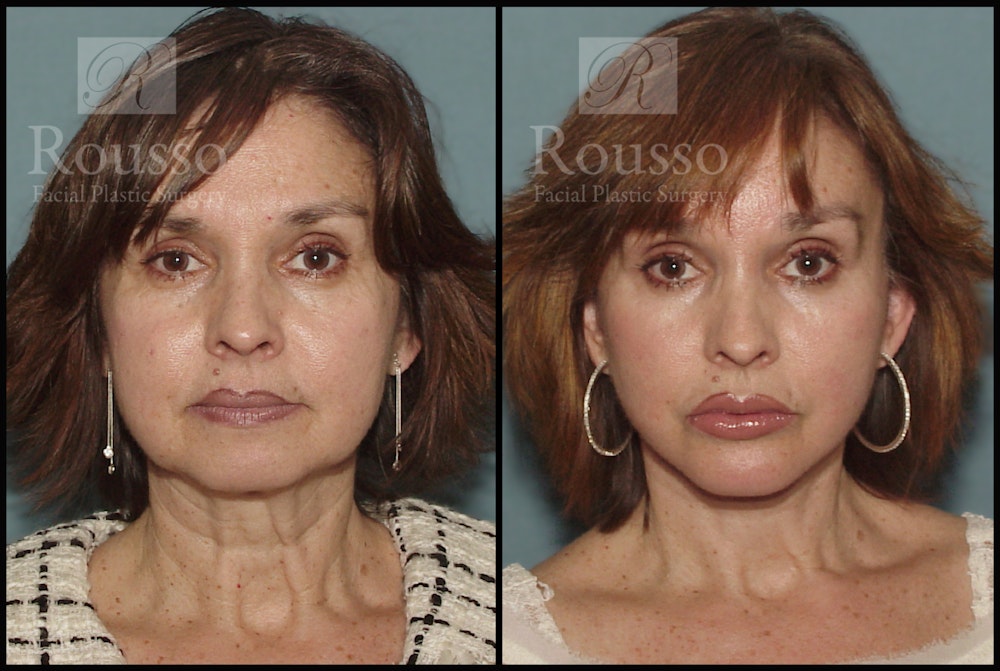 Facelift Before & After Gallery - Patient 1993269 - Image 3