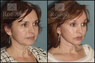 Facelift Before & After Gallery - Patient 1993269 - Image 1
