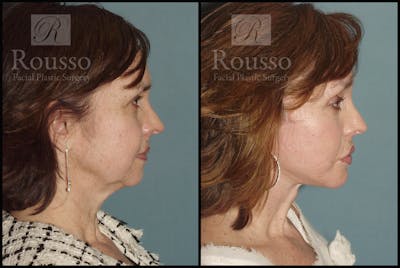Facelift Before & After Gallery - Patient 1993269 - Image 2